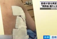 “食人菌”在日本疯传，感染人数创新高