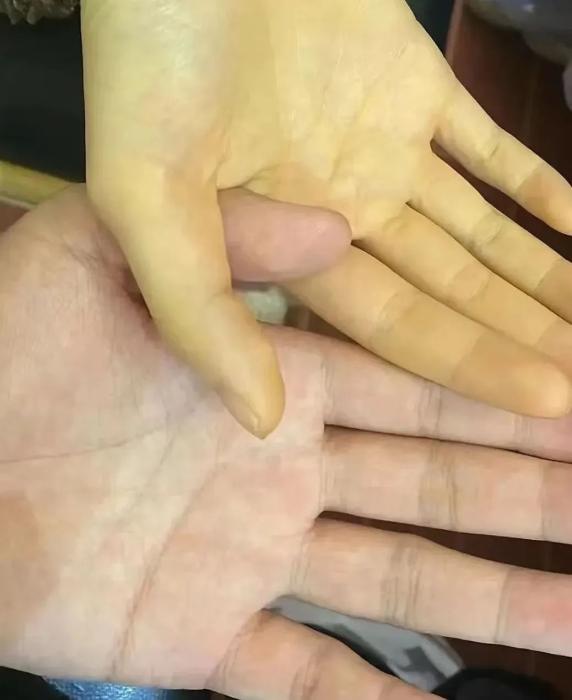吃了一包零食，5岁男孩进了ICU！这些人最易被这种病“盯上”→